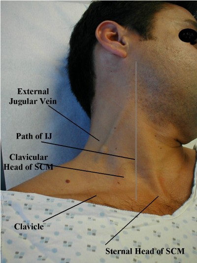 What It Looks Like Jugular Vein Distention Ems Basics 0305