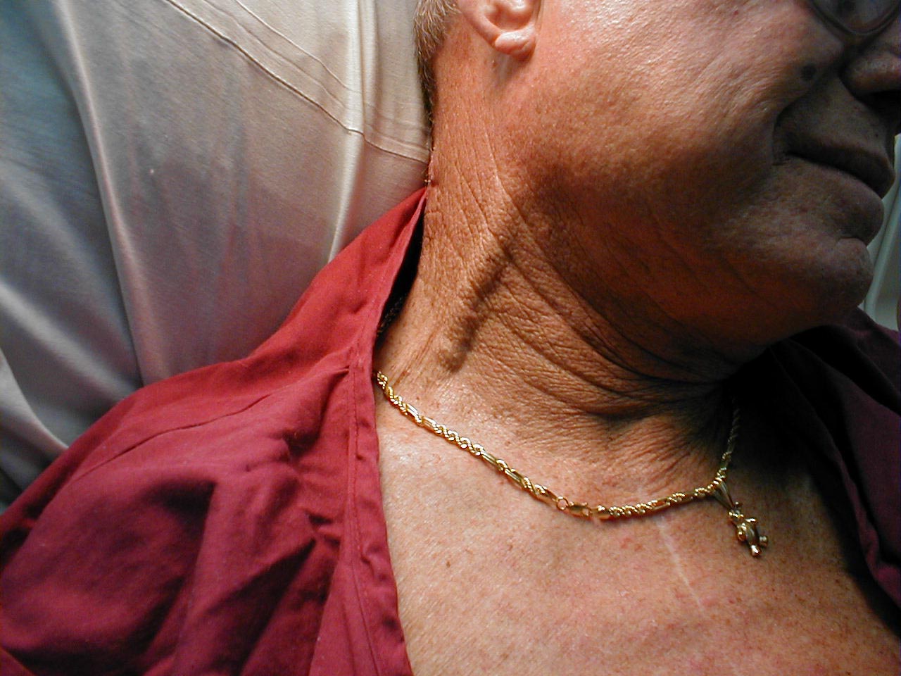 What Do Distended Neck Veins Indicate